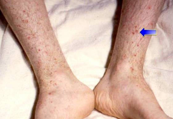 Сепсис крови что это такое, последствия и лечение