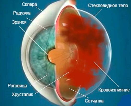 Лопнул сосуд в глазу причины, что делать и как лечить