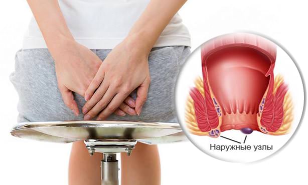 Внешняя локализация геморроидальных узлов