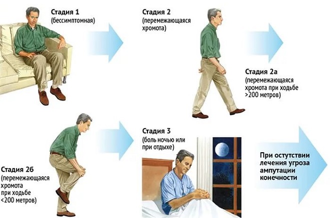 стадии развития атеросклероза