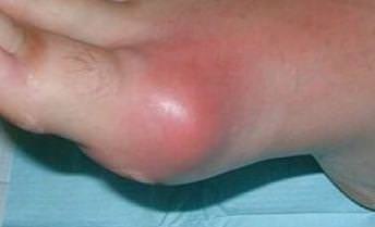 Подагра на ноге