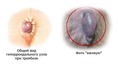 Тромбоз наружного геморроидального узла