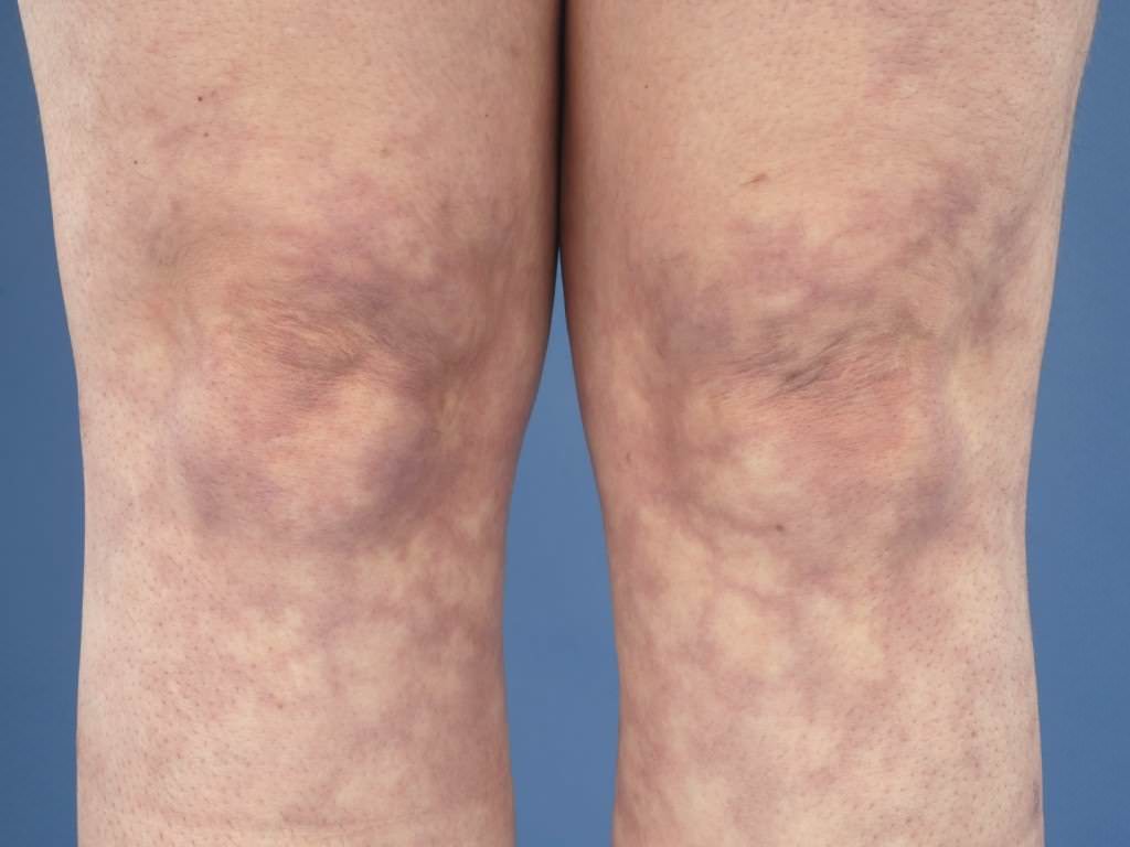 Каковы причины мраморной кожи у взрослых и детей. Симптомы, диагностика и лечение