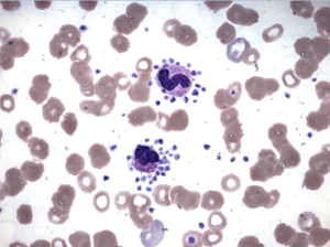 Причины пониженных нейтрофилов у детей и лечение отклонений