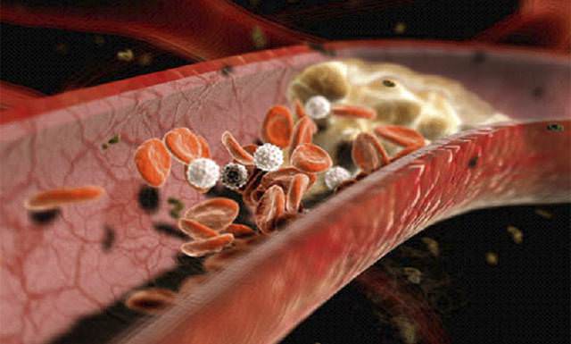 Атеросклеротическая бляшка