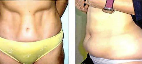 липодистрофия при сахарном диабете