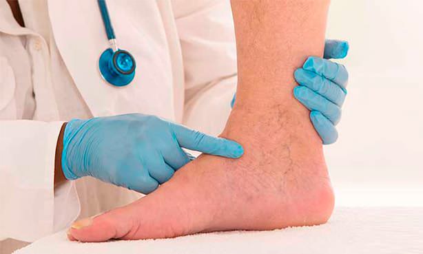 Флебит вен на ногах