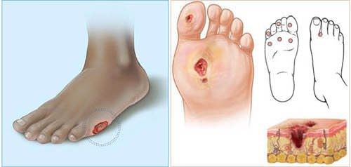 Диабетическая стопа