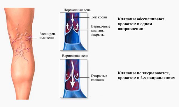 Изображение варикозно расширенной вены в сравнении со здоровой