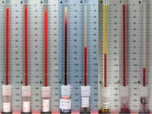 Норма СОЭ в крови при беременности