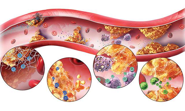 Процесс налипания холестерина на стенки артерии