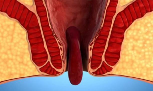 Геморрой, осложненный впадением узла наружу