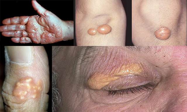 Бляшки на коже