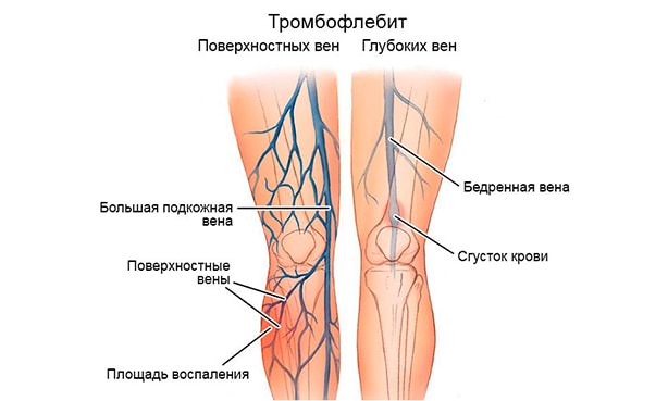 Тромбофлебит нижних конечностей