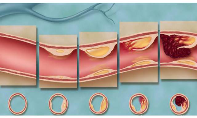 Атеросклероз, стадии формирования бляшки и тромба