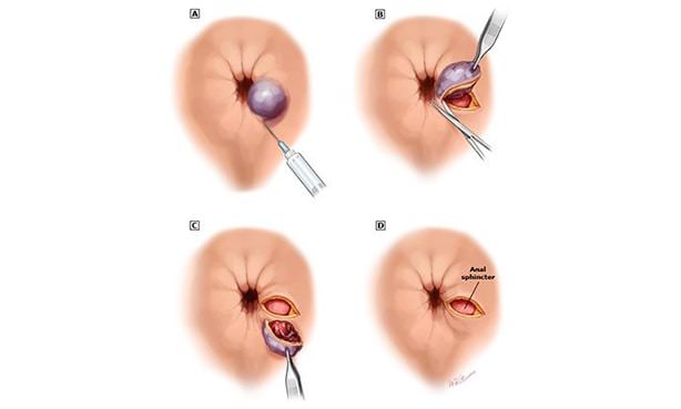 Тромбэктомия