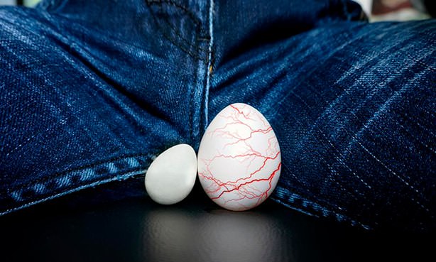 Варикозное расширение левого яичка