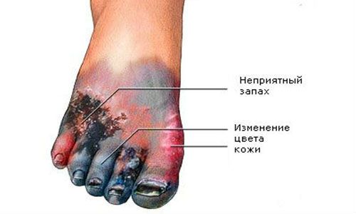 Гангрена ноги