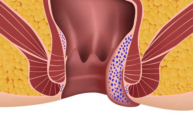 Геморрой 3 степени