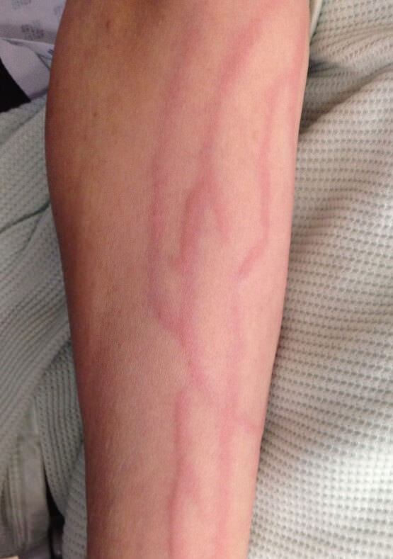 Воспаление вен на руке