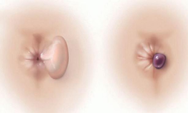 Тромбоз наружного геморроидального узла