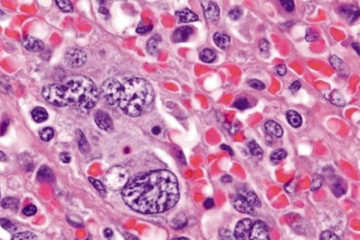 Как диагностировать и лечить сублейкемический миелоз