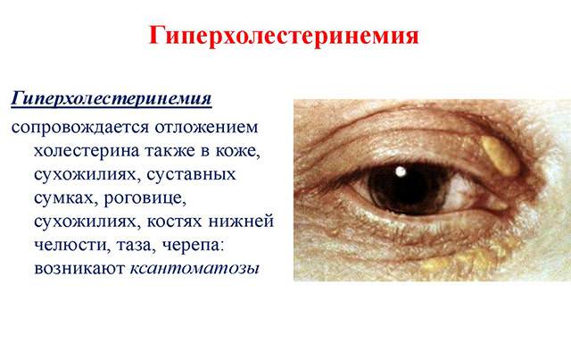 Гиперхолестеринемия