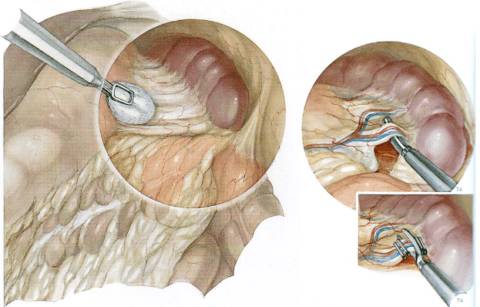 subleykemicheskiy_mieloz_lechenie Как диагностировать и лечить сублейкемический миелоз