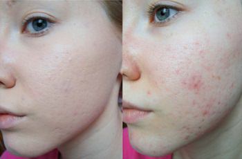 Гель Базирон АС: инструкция по применению от прыщей